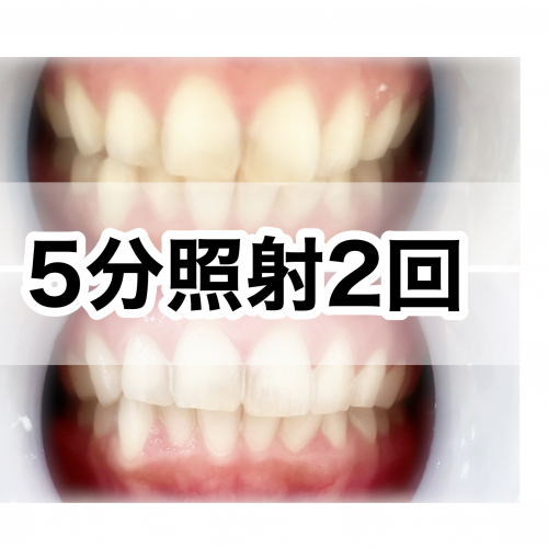 5分照射×２回ホワイトニング