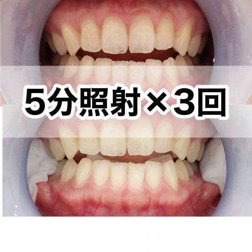 5分照射×３回ホワイトニング